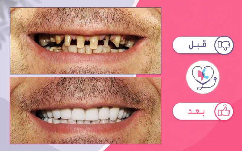 تلبيس الاسنان الاماميه بالصور