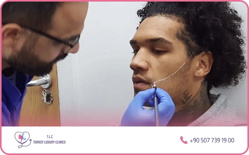 Nombre de greffons (Unités folliculaires) 