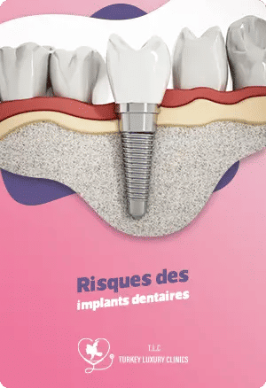Risques liés à l’implant dentaire