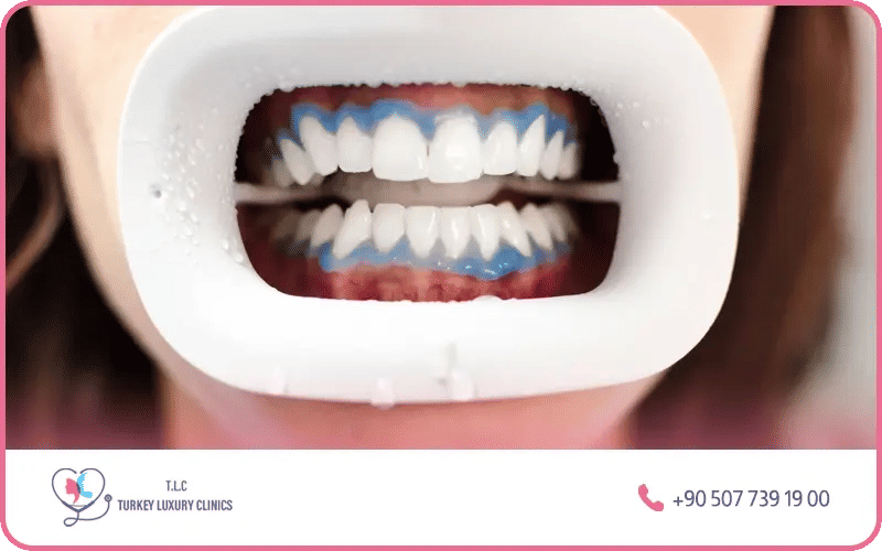 gel de peroxyde d'hydrogène activé par une lumière laser gel de peroxyde d'hydrogène activé par une lumière laser