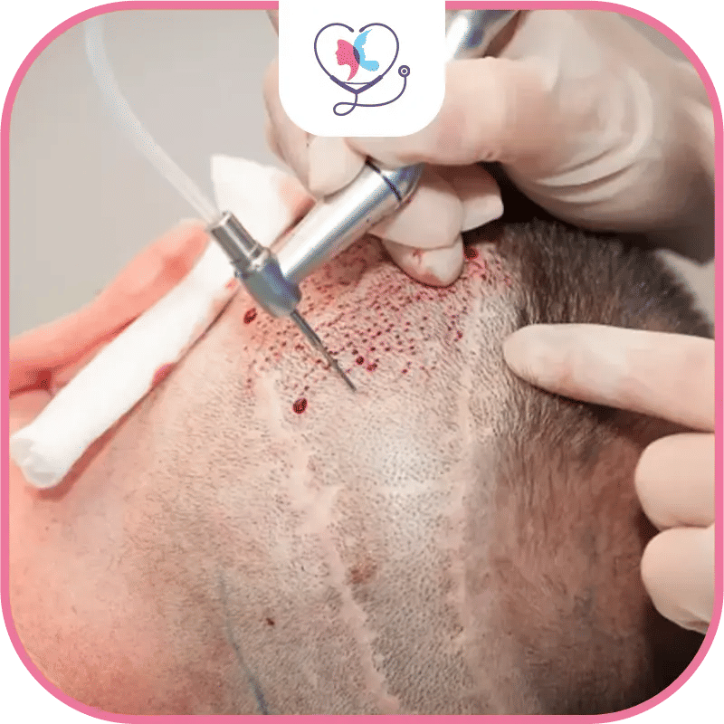 The Efficacy of Hair Transplant