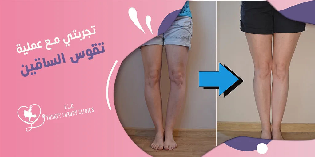 تجربتي مع عملية تقوس الساقين: نسب النجاح أكثر من 90%