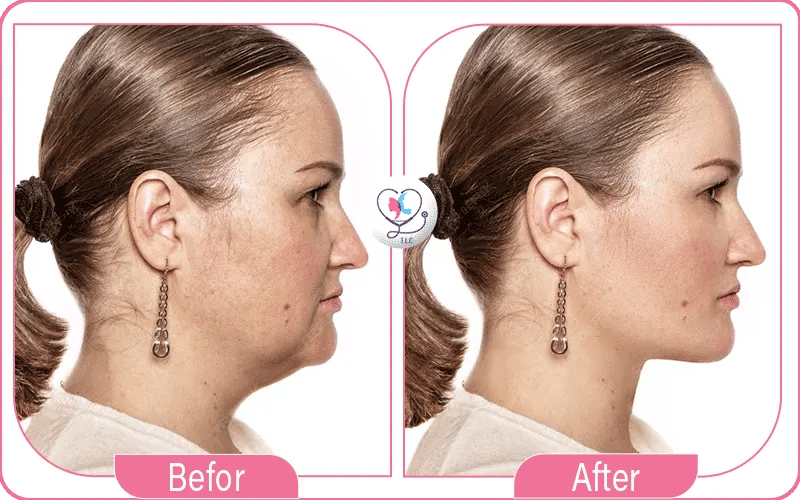 ثالثاً: ميساء و"تجربتي مع شفط اللغلوغ بالخيوط"