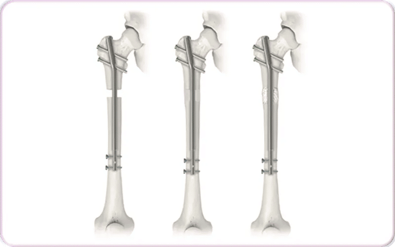 What is Precice Nail?