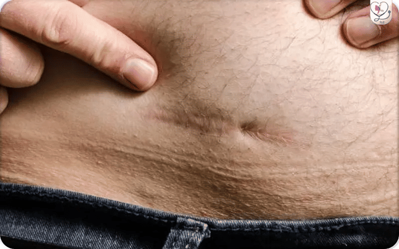 Stomach Healing After Gastric Sleeve