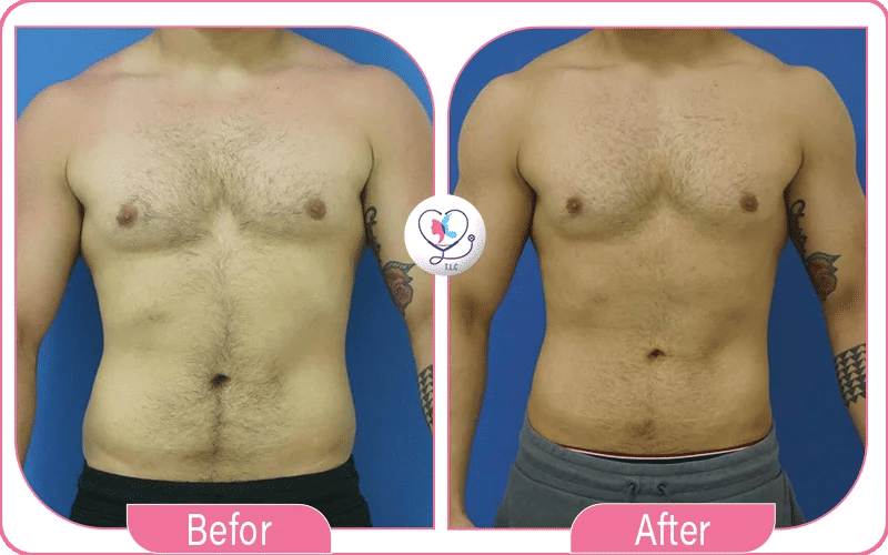 Male 360 Lipo Before and After Photos
