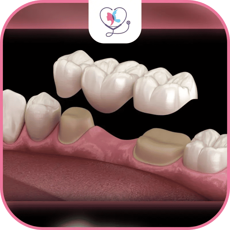 ما هي جسور الأسنان؟