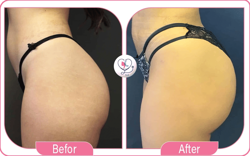 Lipofilling fessier avant / après