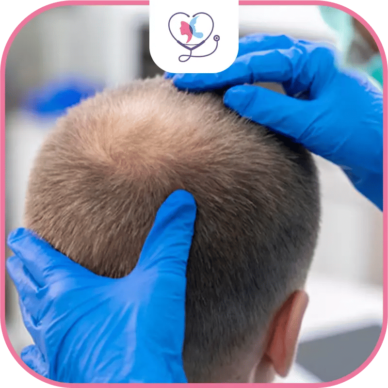 5–6 Months After Hair Transplant (20 24 Weeks)