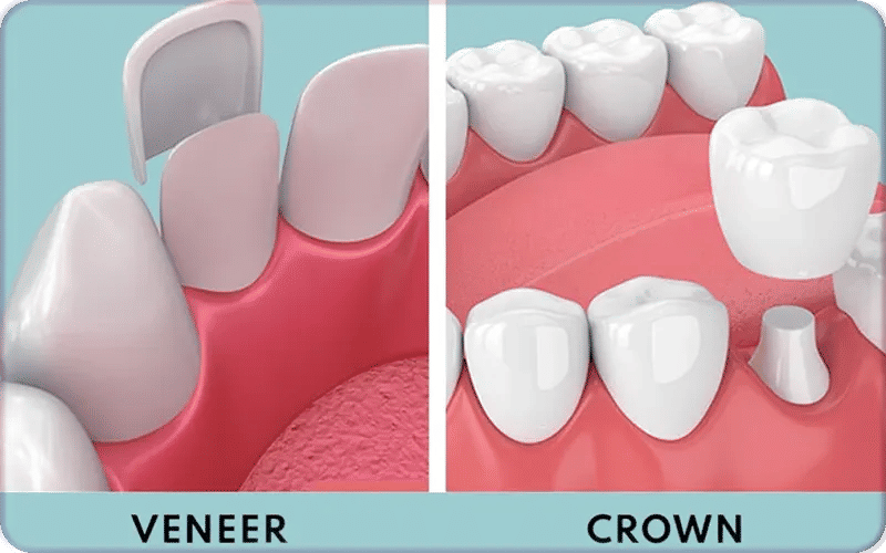 What Are Veneers vs. Crowns?