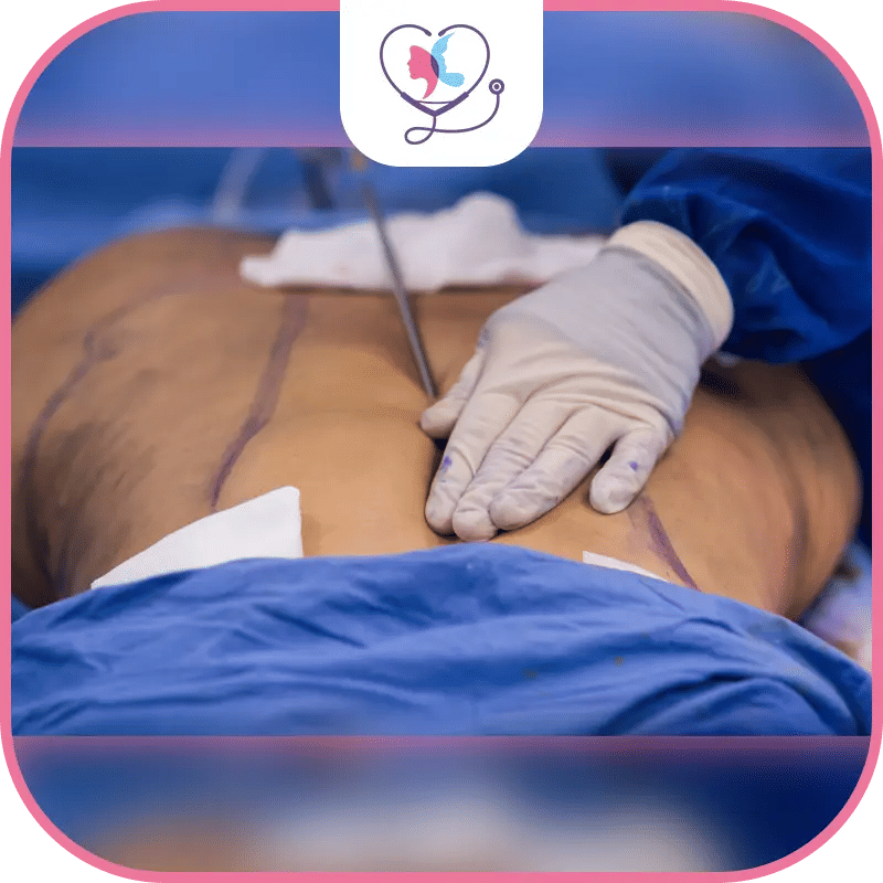 Alimentation après liposuccion : Quel régime adopter ?