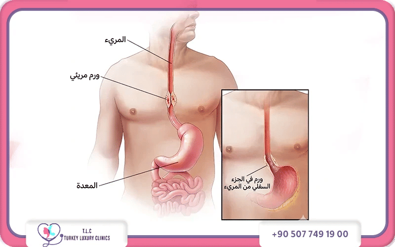 أنواع سرطان المريء