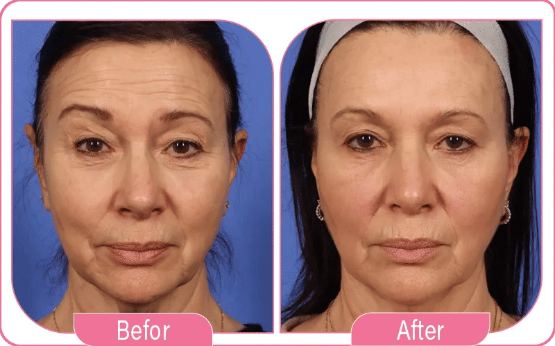 Cosmetic Uses of Facial Botox Injection 2