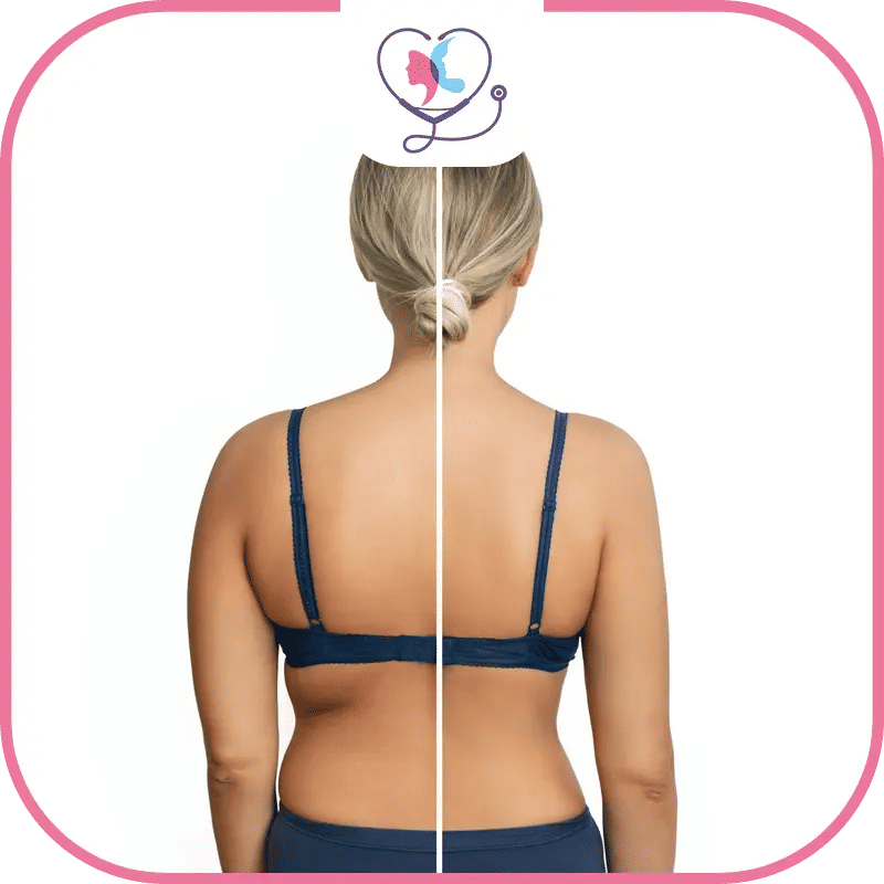 résultats liposuccion dos - photo liposuccion ratée