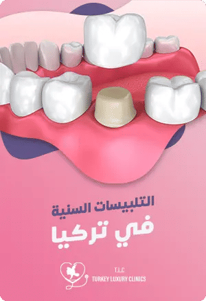 تلبيس الأسنان في تركياfeatured image