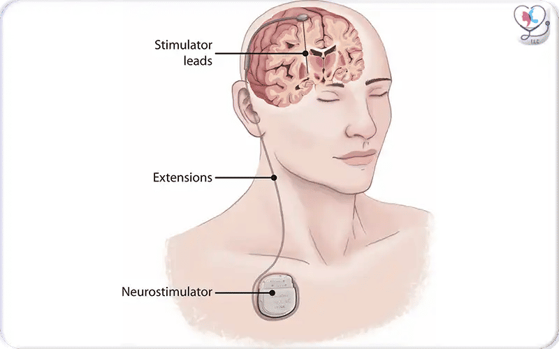 4. Pulse‑Generator Implantation