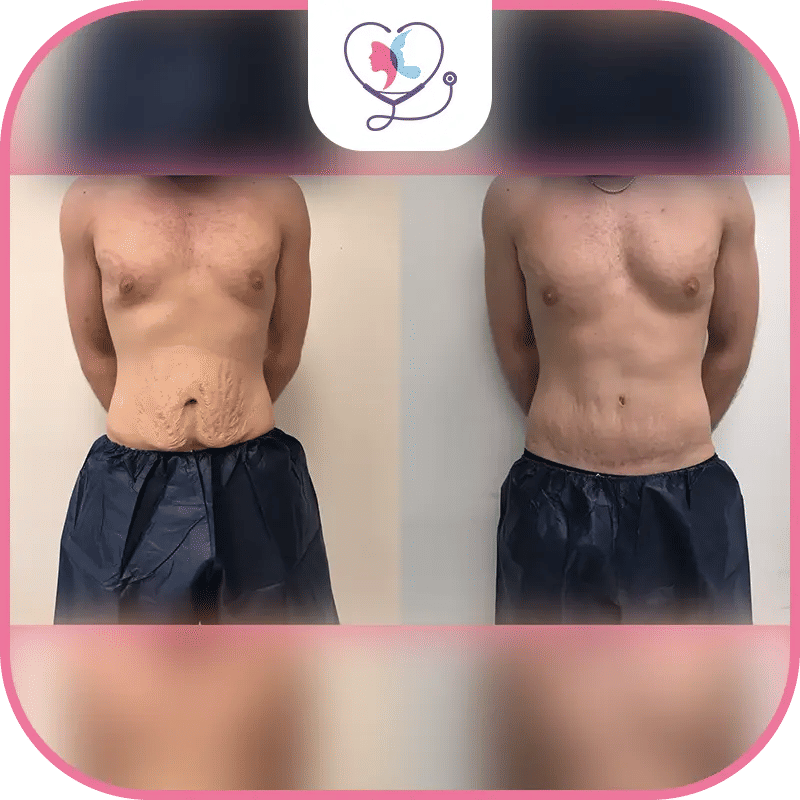 نتائج عملية شد البطن بالصور للرجال
