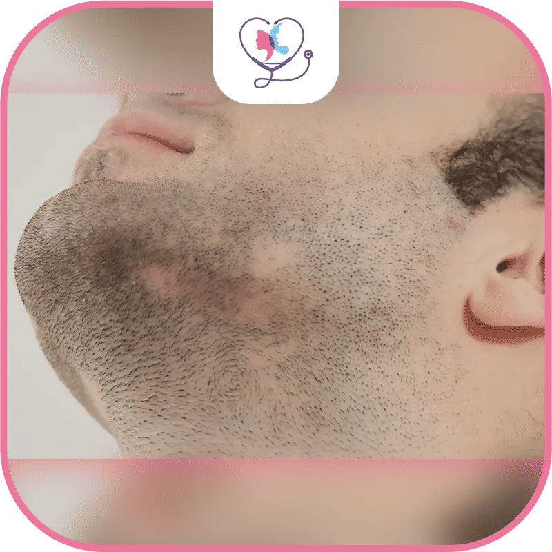 Quelles sont les causes d'une greffe de barbe ratée ?