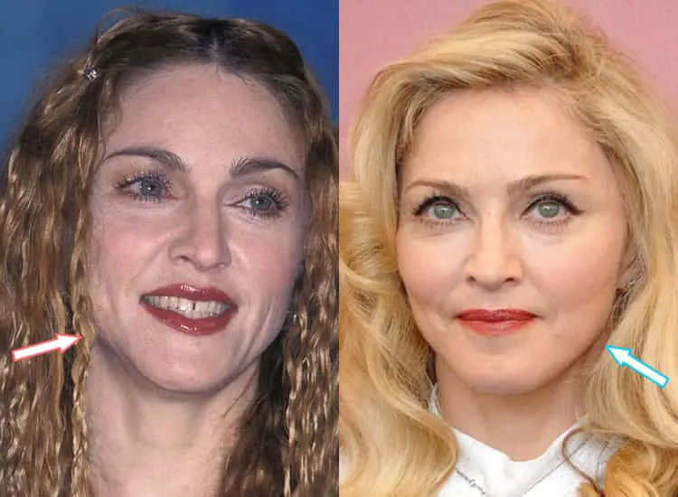 Madonna’s facial appearance highlighting rumored plastic surgery procedures.