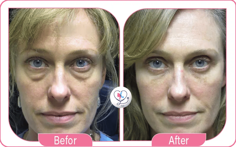 Blépharoplastie inférieure avant après