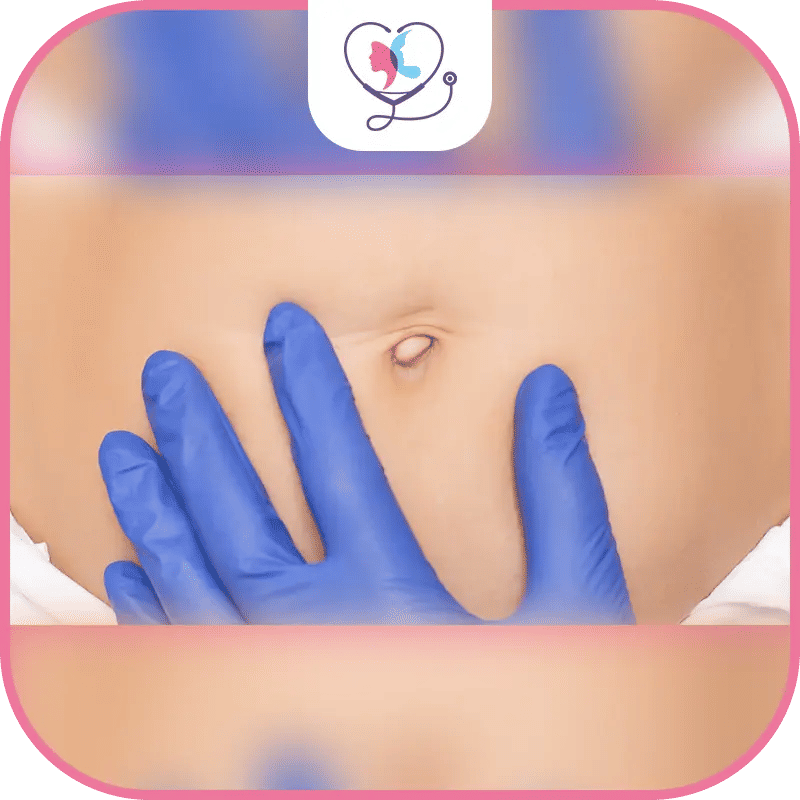 كيف يتغير شكل السرة بعد عملية شد البطن