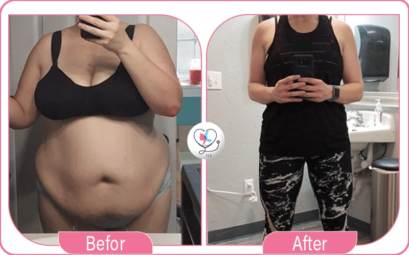 liposuccion ventre avant/après la grossesse