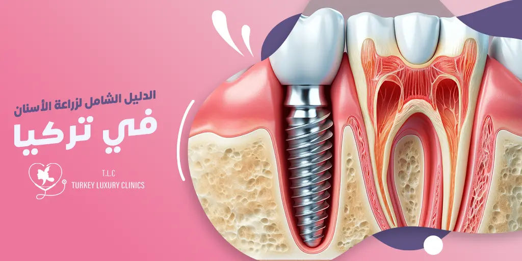 زراعة الأسنان في تركيا: الدليل الشامل