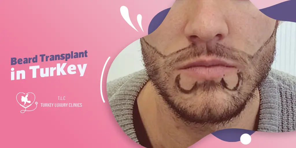 Beard Transplant in Turkey