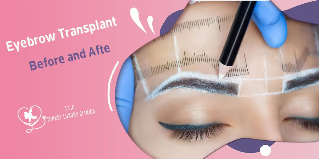 Eyebrow Transplant Before and After: Real Results & Photos 2026