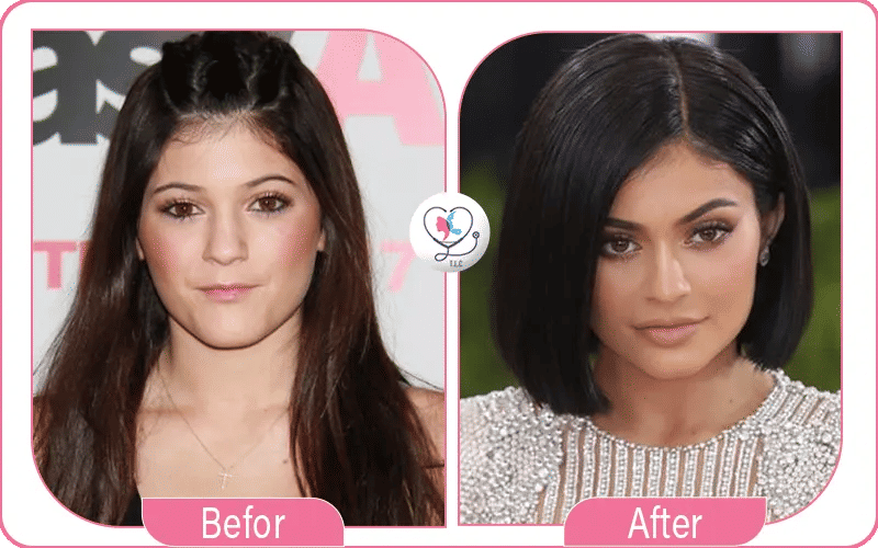 Kylie Jenner avant / après chirurgie-2