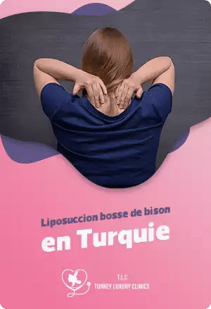 Liposuccion bosse de bison en Turquiefeatured image