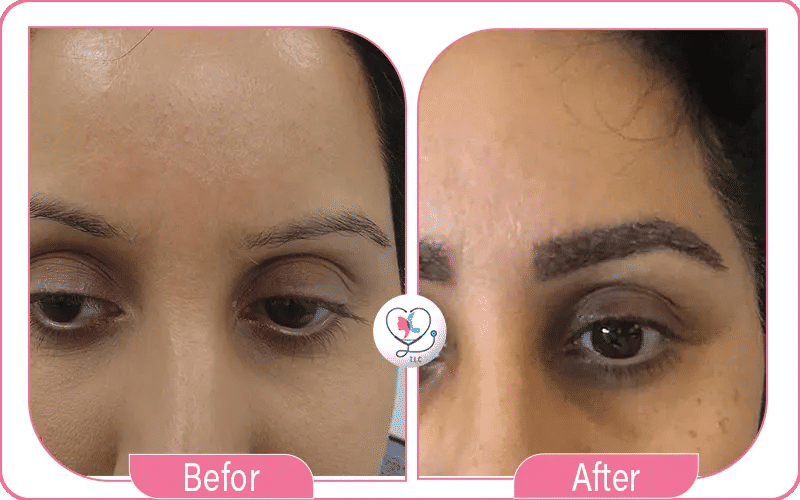 Before Eyebrows Transplant