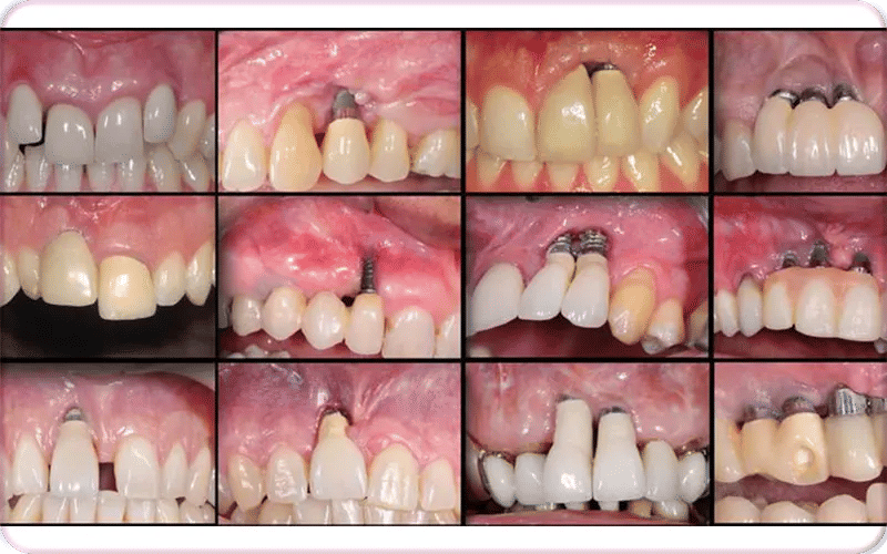 What Are Bad Dental Implants?