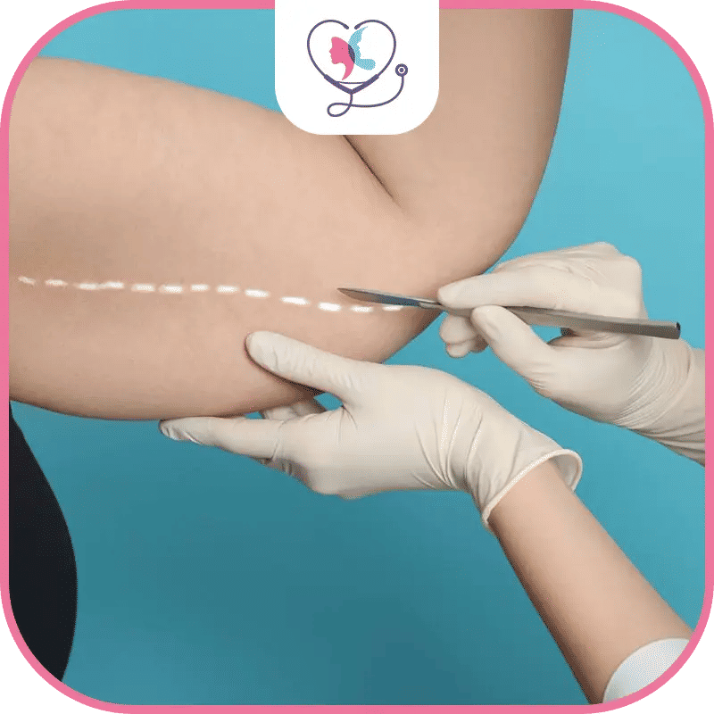 تكلفة عملية شد الذراعين في تركيا