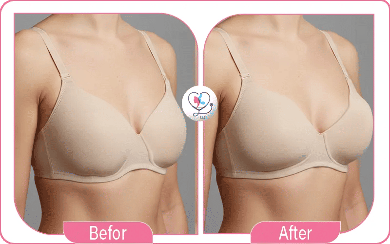 تجارب عملية شد وتكبير الثدي
