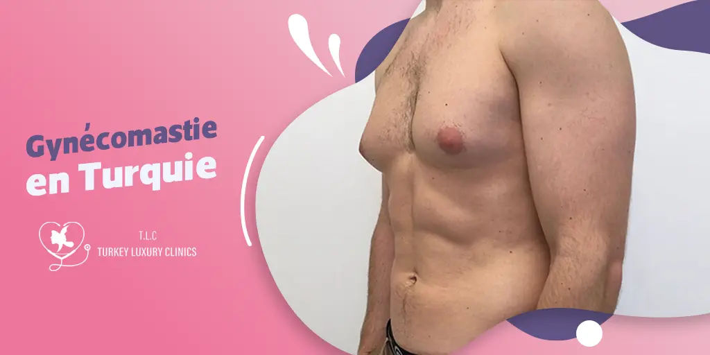 Gynécomastie en Turquie : Réduction mammaire abordable pour hommes