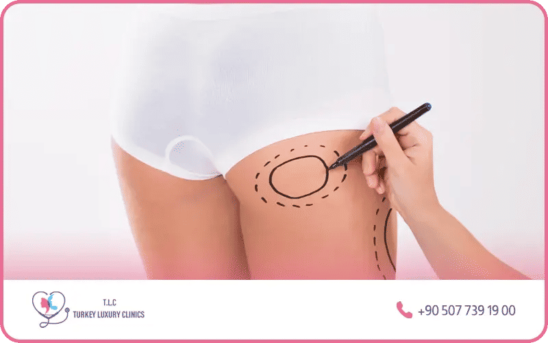 Le prix d’un BBL (Brazilian Butt Lift) en Turquie Le prix d’un BBL (Brazilian Butt Lift) en Turquie