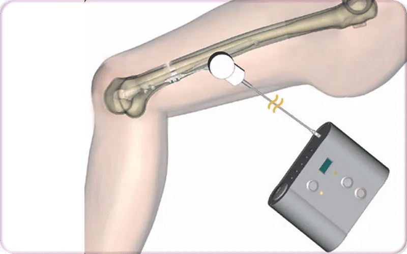 Advantages of Fitbone Orthofix for Limb Lengthening System