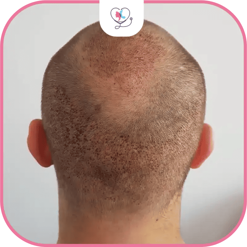 Hair Transplant for Crown Balding