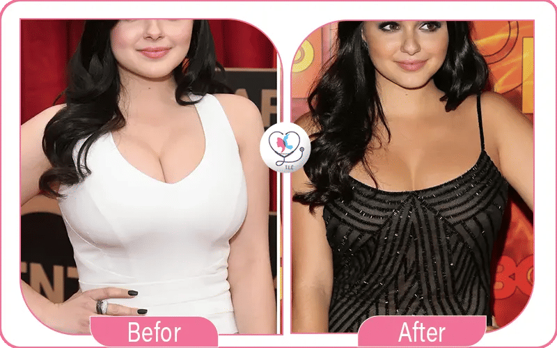 Did Ariel Winter Have a Breast Reduction?