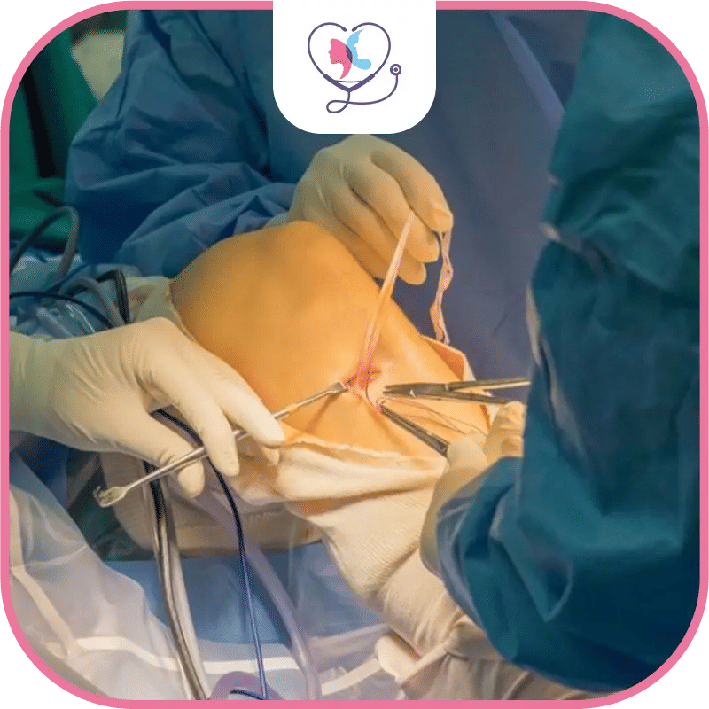 Partial Knee Replacement Procedure Steps