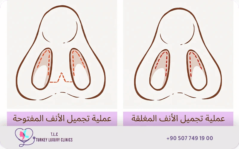 ما هي عملية تصغير الانف؟