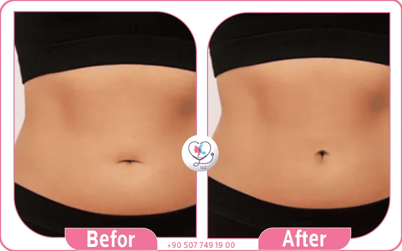 خطوات عملية تجميل السرة خطوات عملية تجميل السرة