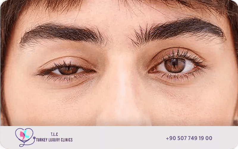 ما هي اعراض ارتخاء الجفن؟