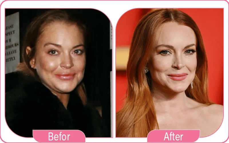 What Do Experts Say About Lindsay Lohan’s Facelift?