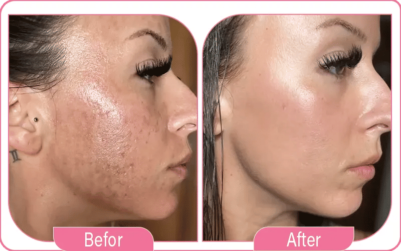 lifting laser avant apres