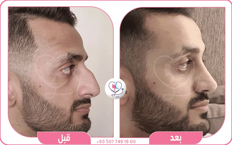 كيفية تصغير غضروف الانف