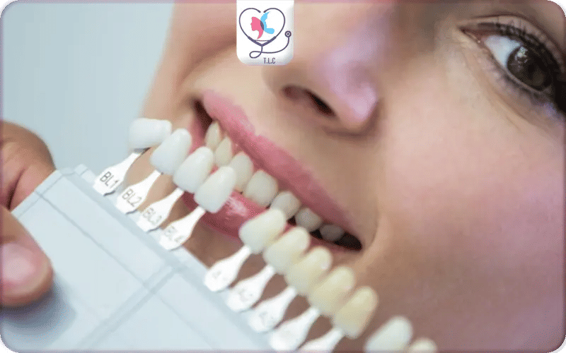 What are Porcelain Veneers?