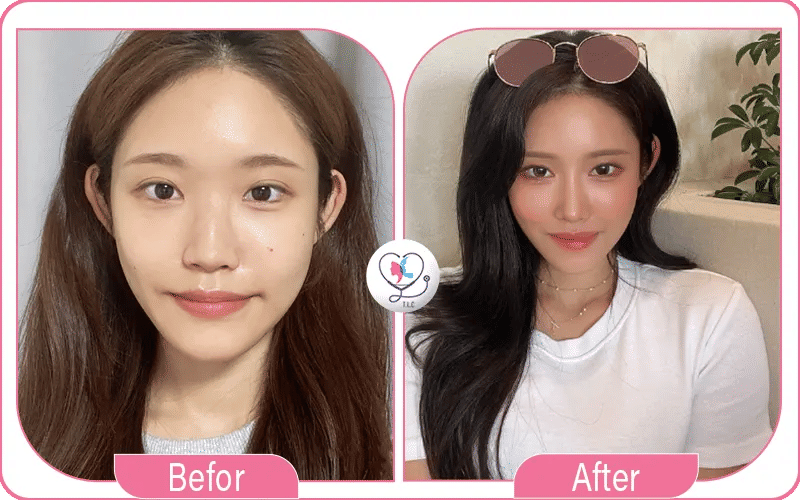 فوائد عملية تجميل الأنف الأفطس