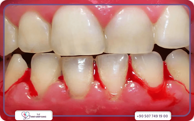 ما هي أعراض نزيف اللثة؟